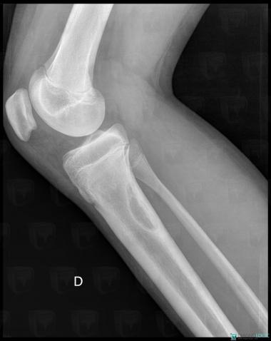 Nonossifying fibroma, Tibia - Mid part, X rays