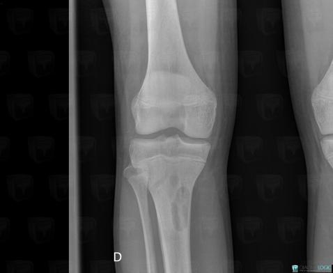 Nonossifying fibroma, Tibia - Mid part, X rays