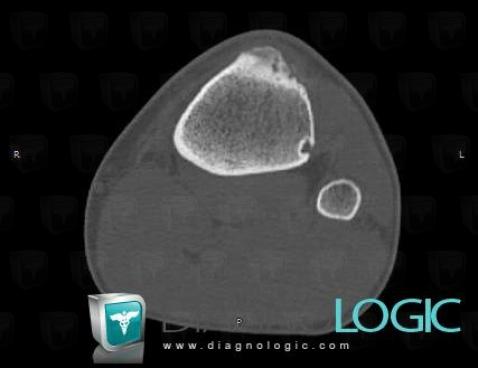 Nonossifying fibroma, Tibia - Proximal part, CT