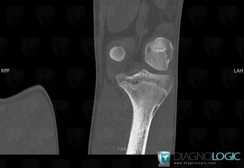 Nonossifying fibroma, Tibia - Proximal part, CT