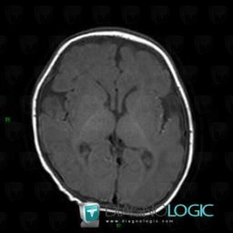 Normal myelination in pediatric brain, Cerebral hemispheres, MRI