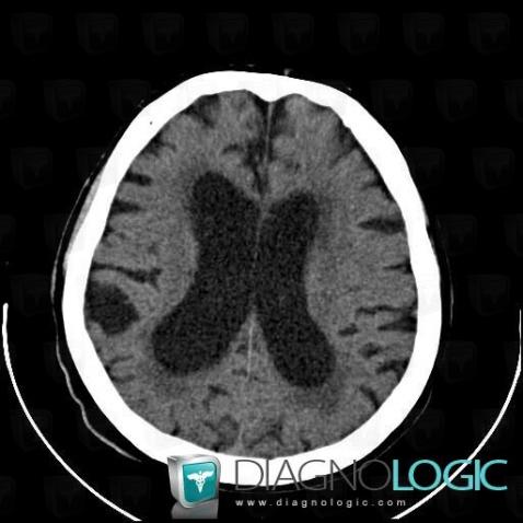 Normal pressure hydrocephalus , Ventricles / Periventricular region, CT