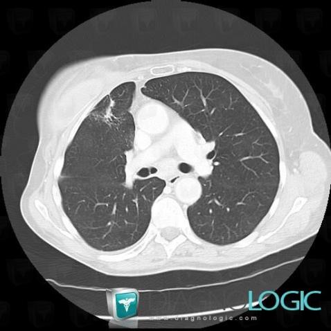 Radiology case : Normal variant (CT) - Diagnologic