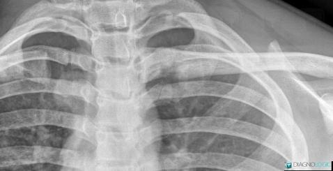 Normal variant, Clavicle, X rays