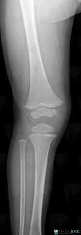 Normal variant, Femur - Distal part, X rays