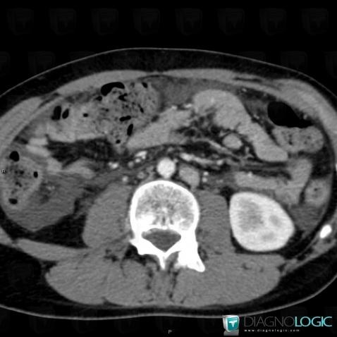 Normal variant, Inferior vena cava, CT