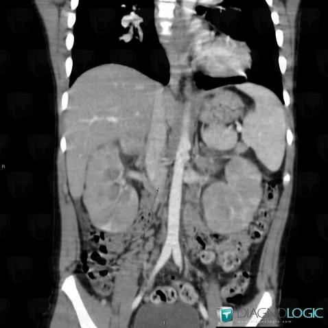 Normal variant, Inferior vena cava, CT