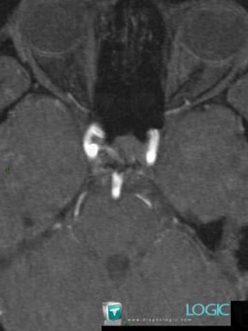 Normal variant, Internal carotid artery, MRI