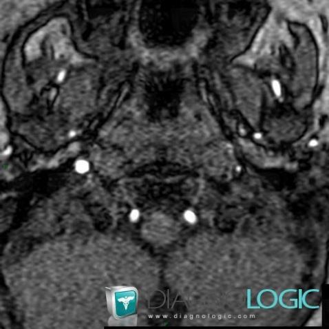 Normal variant, Internal carotid artery, MRI