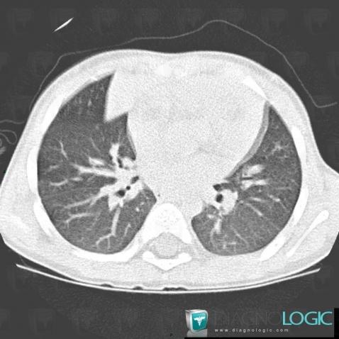 Normal variant, Mediastinum, CT