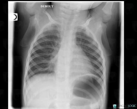 Normal variant, Mediastinum, X rays