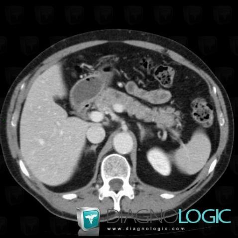 Normal variant, Pancreas, CT