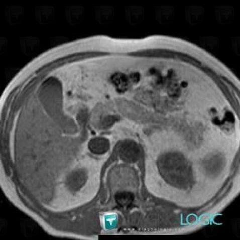 Normal variant, Pancreas, MRI