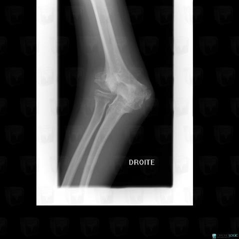 Normal variant, Radius - Proximal part, X rays