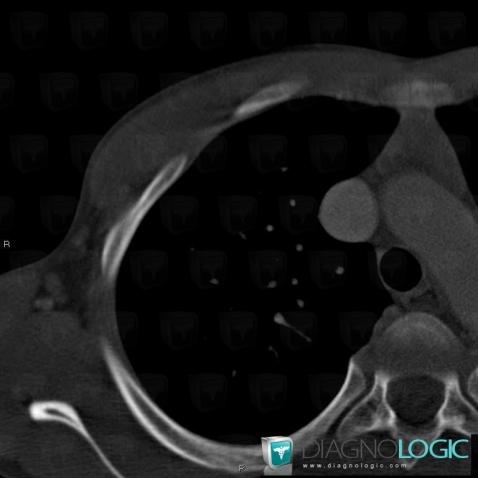 Radiology case : Normal variant (X rays ,CT) - Diagnologic