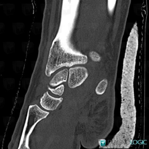 Normal variant, Scaphoid, CT