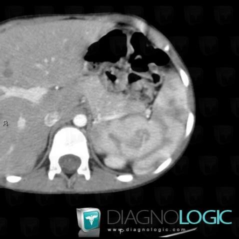 Normal variant, Spleen, CT