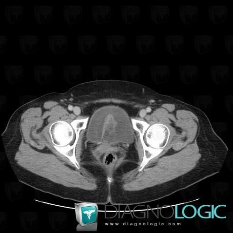 Normal variant, Urinary bladder, CT