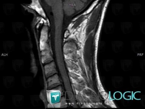 Normal variant, Vertebral body / Disk, MRI