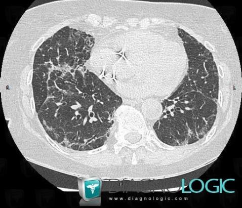 NSIP, Pulmonary parenchyma, Airways, CT