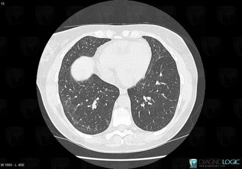 NSIP, Pulmonary parenchyma, CT