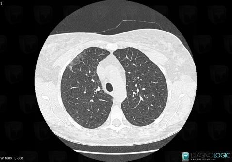 NSIP, Pulmonary parenchyma, CT