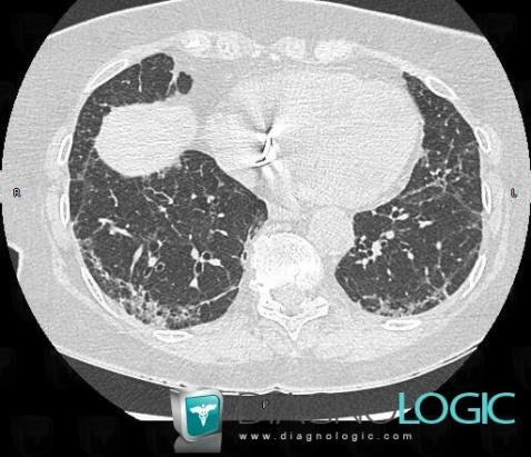 NSIP, Pulmonary parenchyma, CT