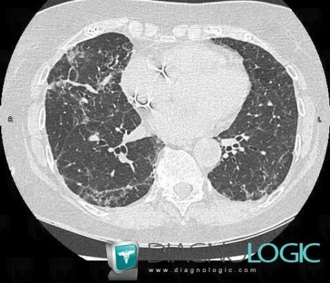 NSIP, Pulmonary parenchyma, CT