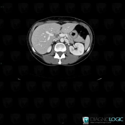 Nutcracker syndrome, Abdominal aorta branches, Other veins - Abdomen, CT