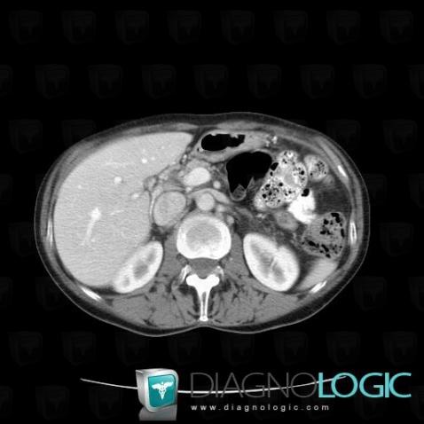 Nutcracker syndrome, Abdominal aorta branches, Other veins - Abdomen, CT