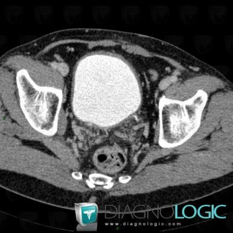 Obstruction chronique vésicale, Vessie, Scanner