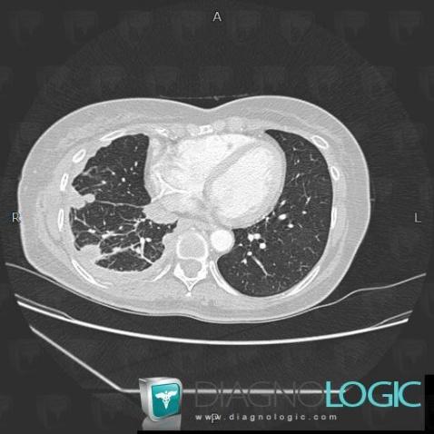 Obstruction lymphatique, Parenchyme pulmonaire, Scanner