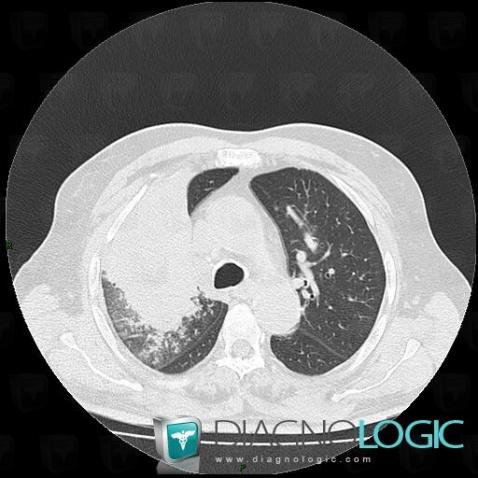 Obstructive pneumonia, Pulmonary parenchyma, CT