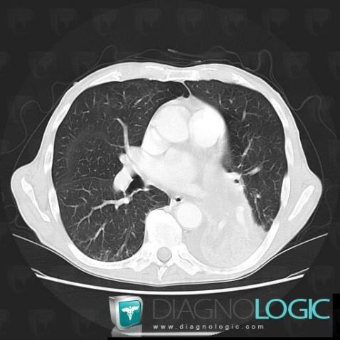 Obstructive pneumonia, Pulmonary parenchyma, CT