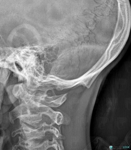 Occipital horn syndrome, Skull vault, X rays