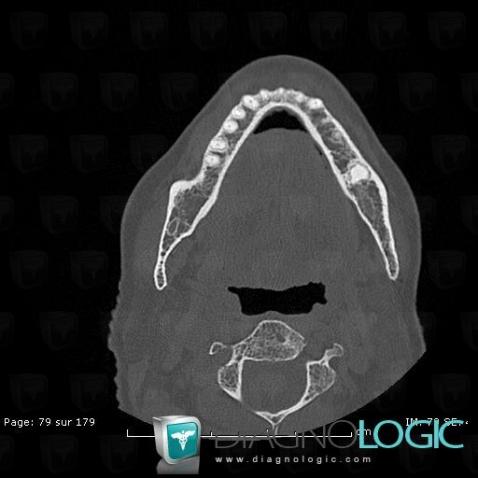 Odontoma, Mandible, CT