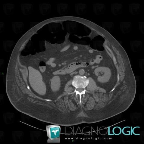 Ogilvie  syndrome, Colon, CT