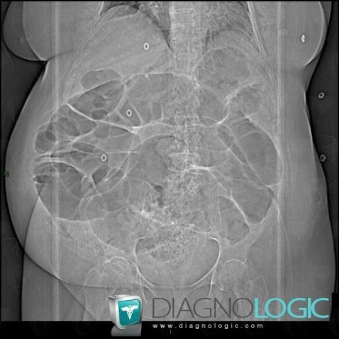 Ogilvie  syndrome, Colon, X rays