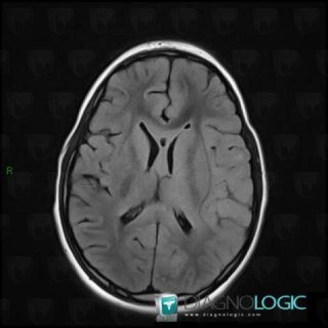 Oligodendroglioma, Basal ganglia and capsule, MRI