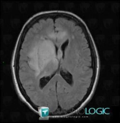 Oligodendroglioma, Basal ganglia and capsule, MRI