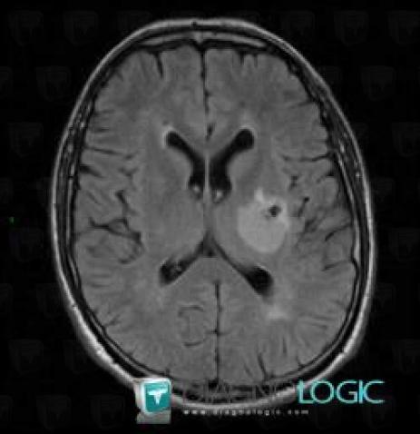 Oligodendroglioma, Basal ganglia and capsule, MRI