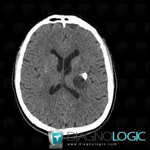 Oligodendroglioma, Cerebral hemispheres, Basal ganglia and capsule, CT