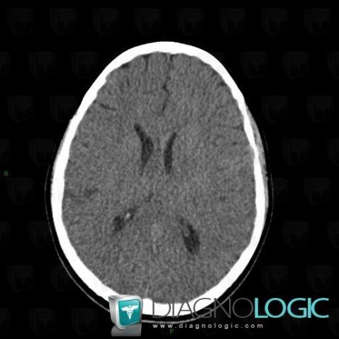 Oligodendroglioma, Cerebral hemispheres, CT