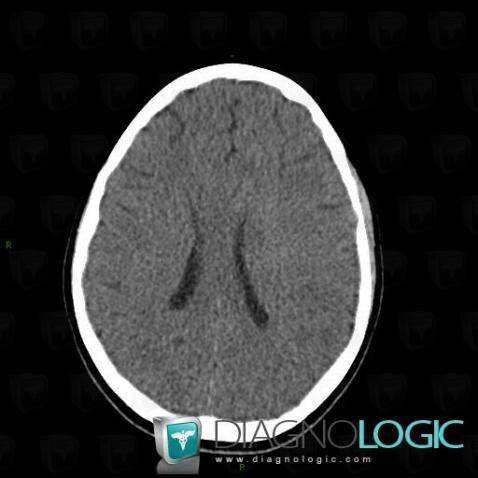 Oligodendroglioma, Cerebral hemispheres, CT