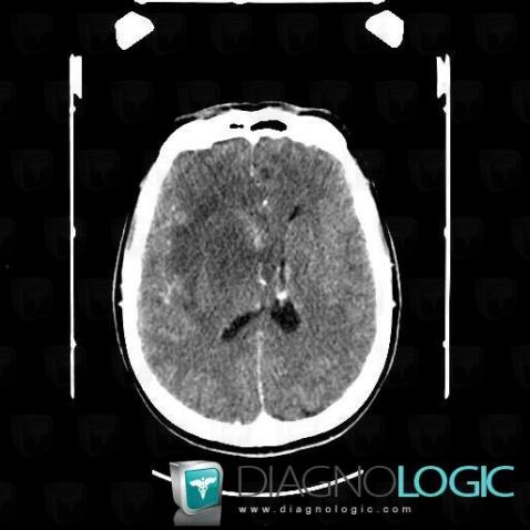 Oligodendroglioma, Cerebral hemispheres, CT