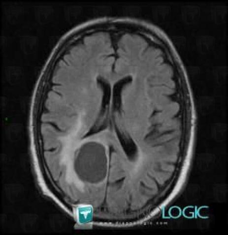 Oligodendroglioma, Cerebral hemispheres, MRI