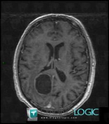 Oligodendroglioma, Cerebral hemispheres, MRI