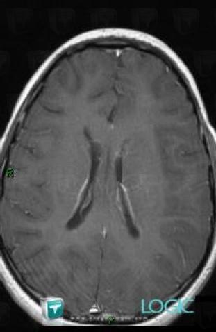 Oligodendroglioma, Cerebral hemispheres, MRI