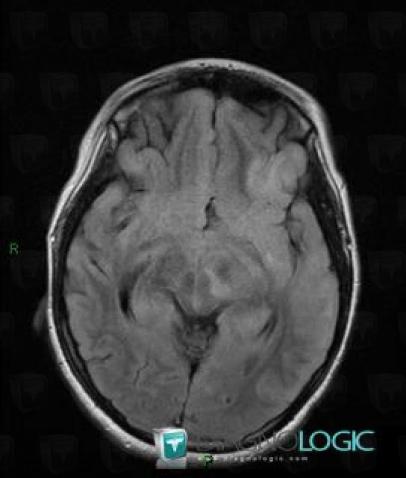 Oligodendroglioma, Cerebral hemispheres, MRI