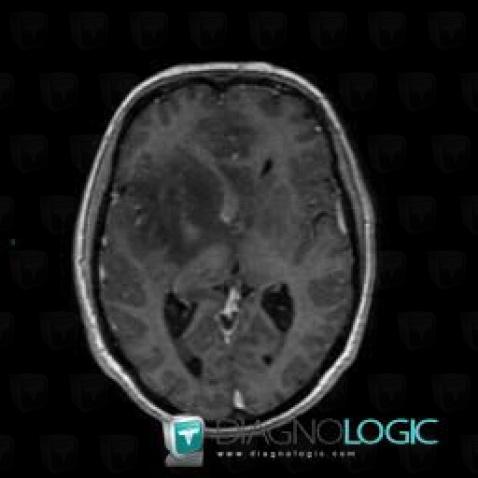 Oligodendroglioma, Cerebral hemispheres, MRI